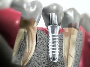 Плюсы и минусы имплантации зубов