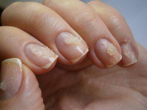 Красота: как восстановить ногти после шеллака